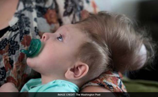 'We Had No Hope': The Amazing Story Of The Baby Born With His Brain Outside His Skull