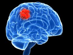 World Brain Tumor Day: आज है विश्व ब्रेन ट्यूमर दिवस, जानिए क्यों मनाया जाता है यह दिन और क्या है इसका महत्व