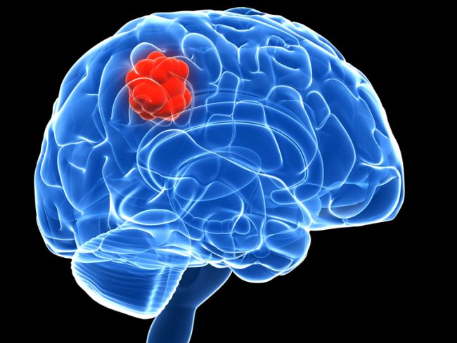 Virus That Can Help Treat Brain Tumours Identified
