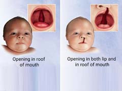 India Has Over 72,000 With Cleft Lip And Palate