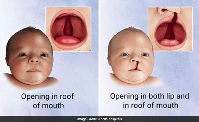 Baby With Cleft Lip Palate Types Causes And Treatment - Vrogue