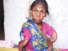 36 Dead In Jharkhand Village Of Skeletal Fluorosis
