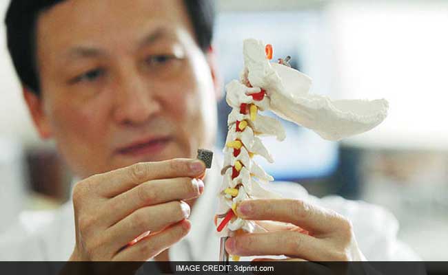 Chinese Doctors Succeed In Rare 3D-Printed Vertebrae Implant