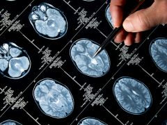 Decreased Blood Flow in Brain Earliest Sign of Alzheimer's Decreased Blood Flow in Brain Earliest Sign of Alzheimer's