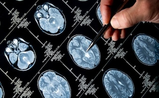 Decreased Blood Flow in Brain Earliest Sign of Alzheimer's