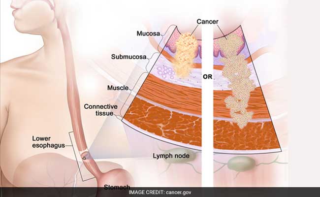 Rare Gene Mutation Linked To Oesophageal Cancer Discovered