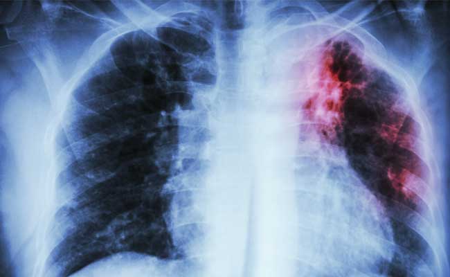 Fibrosis Plays A Role In Ageing