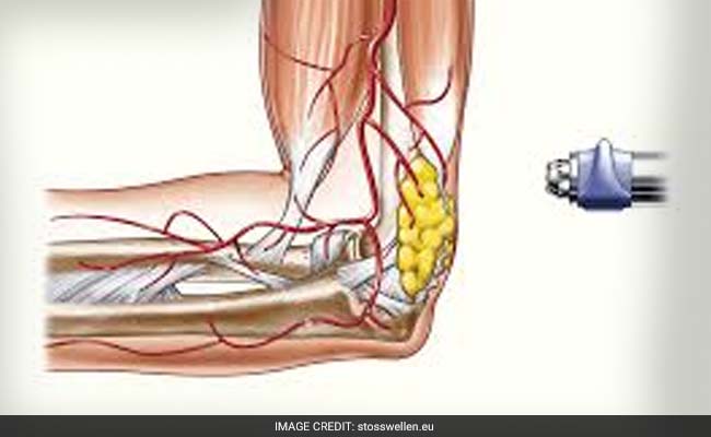 Electric Shock Therapy Muscles
