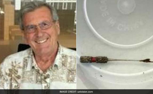 A Dentist Lost A Barbed Tool During A Root Canal. It Was Later Found In Her Patient's Stomach.