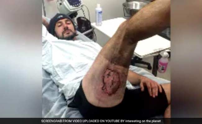 Man Sustains Severe Burns After iPhone 6 Explodes In His Pocket