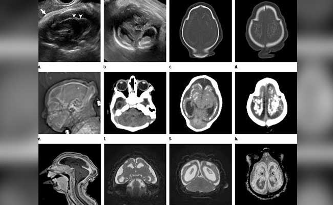 Study Shows Extent Of Brain Damage From Zika Infections