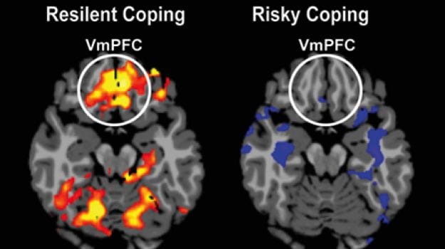 Yale Researchers Find the Part of the Brain That Determines How Well You Handle Stress