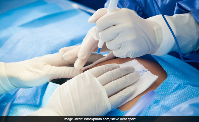 C-Section May Increase Risk Of Blood Clot In Vein: Study