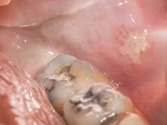 New Dental Fillings May Repair Tooth Decay