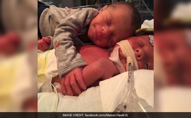 Photo Of Hugging Twins Went Viral. One Of Them Has Died.