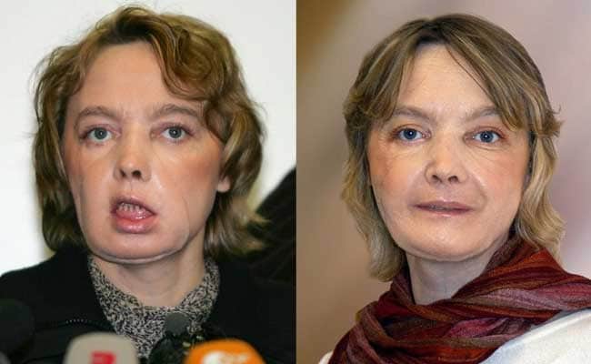Woman Who Received World's First Face Transplant Dies