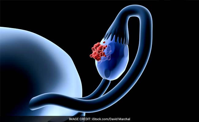 New Blood Test May Improve Treatment For Ovarian Cancer Patients