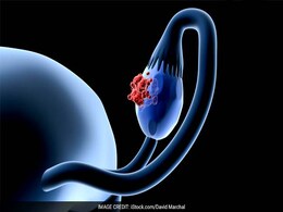 World Ovarian Cancer Day 2024: These Factors Might Increase Your Risk Of OC World Ovarian Cancer Day 2024: These Factors Might Increase Your Risk Of OC