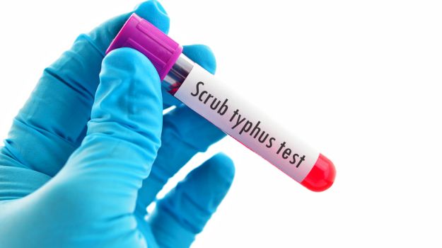 Scrub Typhus Claims 24 Lives In Himachal