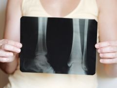 High Cholesterol Can Cause Bone Loss High Cholesterol Can Cause Bone Loss