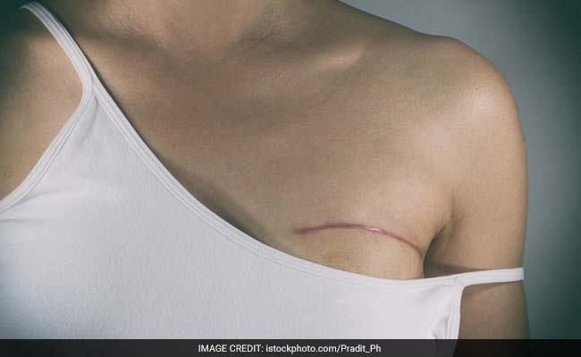 Breast Removal And Reconstruction Is More Risky, Costly: Study