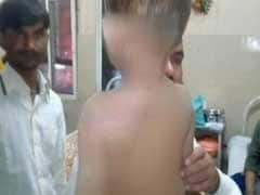 2-Year-Old Suffers Burns As Teen Spills Petrol On Him In Hyderabad