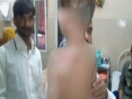 2-Year-Old Suffers Burns As Teen Spills Petrol On Him In Hyderabad 2-Year-Old Suffers Burns As Teen Spills Petrol On Him In Hyderabad