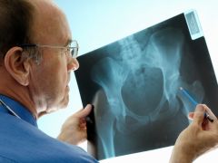 For Osteoporosis, Early Treatment Is Crucial