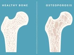 World Osteoporosis Day 2016: Foods That Can Lead to Bone Loss