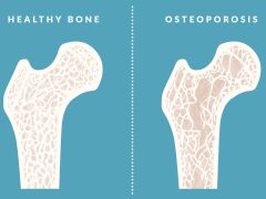Osteoporosis Prevention: महज झुकने, खांसने या छींकने से ही टूट सकती हैं हड्डियां! इन चीजों को खाने से बचें