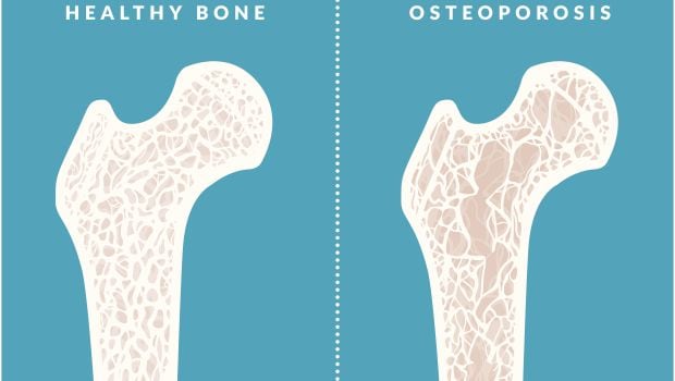 World Osteoporosis Day 2016: Foods That Can Lead to Bone Loss