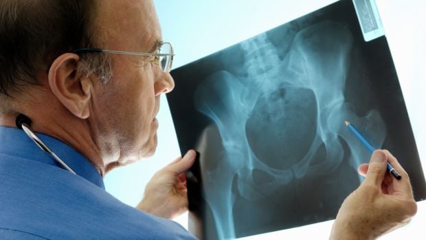 For Osteoporosis, Early Treatment Is Crucial