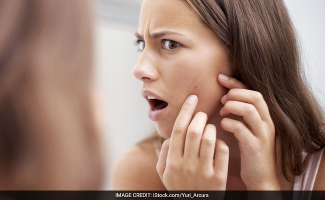 Acne Sufferers May Age Slowly, Say Study