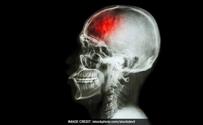 People Suffering Mini-Strokes More Likely To Suffer Major Strokes