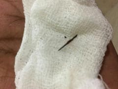 Needle Removed From Man's Body In Kerala After 22 Years