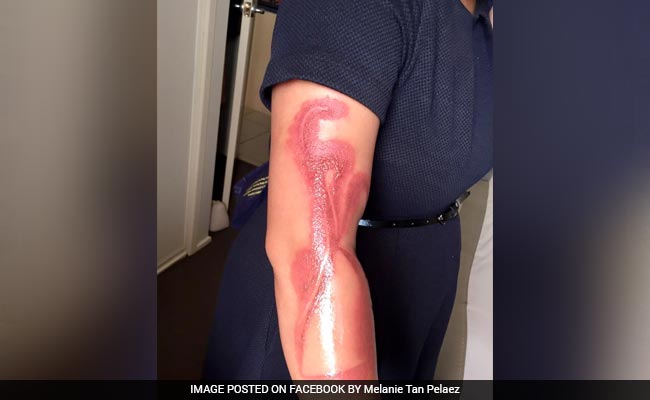 Australian Woman Suffers Burns After Falling Asleep On Her iPhone