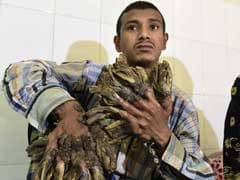 Bangladesh 'Tree Man' Sees Hope After 16 Surgeries