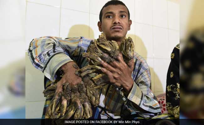 Bangladesh 'Tree Man' Sees Hope After 16 Surgeries