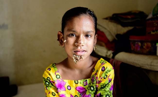 Bangladesh Treats First Case Of 'Tree Girl' Syndrome, She's Just 10