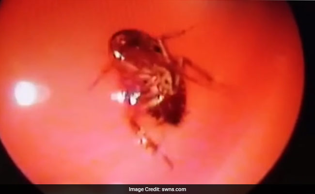 Doctor Pulls Out Live Cockroach From Chennai Woman's Skull