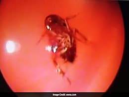 Doctor Pulls Out Live Cockroach From Chennai Woman's Skull Doctor Pulls Out Live Cockroach From Chennai Woman's Skull