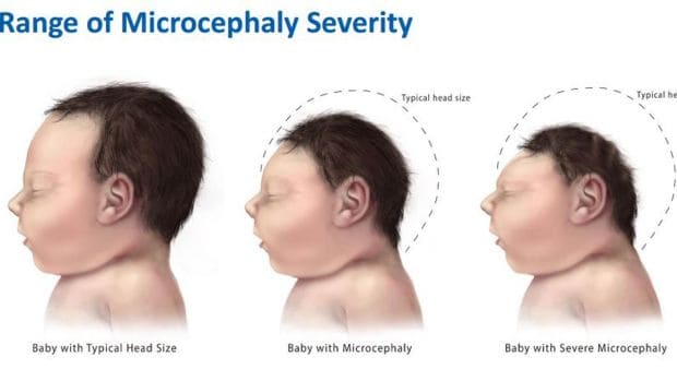 Rare Disease Day Its Significance 7 Most Rare Diseases In The World Ndtv Food