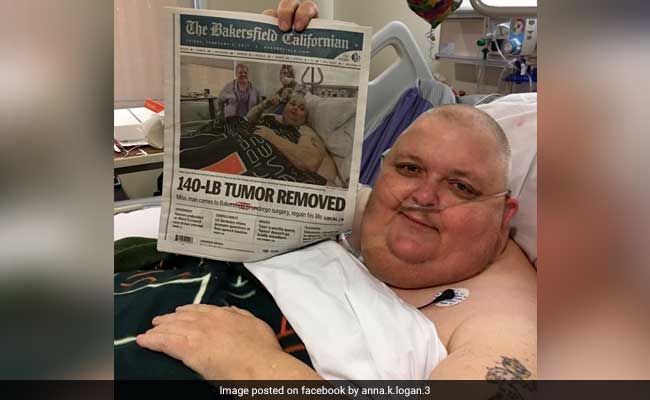 'You're Just Fat' He Was Told. It Was Actually 130-Pound Abdominal Tumour