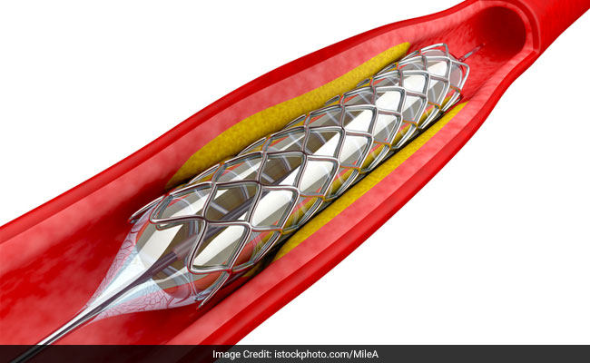 Government Tells Hospitals To Follow Notification On Capping Stent Prices