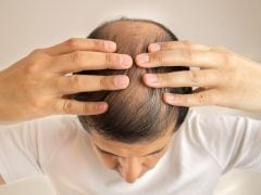 Balding Issues in Short Men Could Also Indicate Cancer Risk