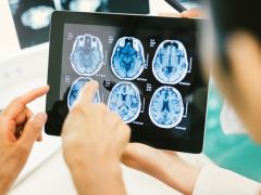 3-D Mini Brains May Help Experts Study Rare Brain Disorders