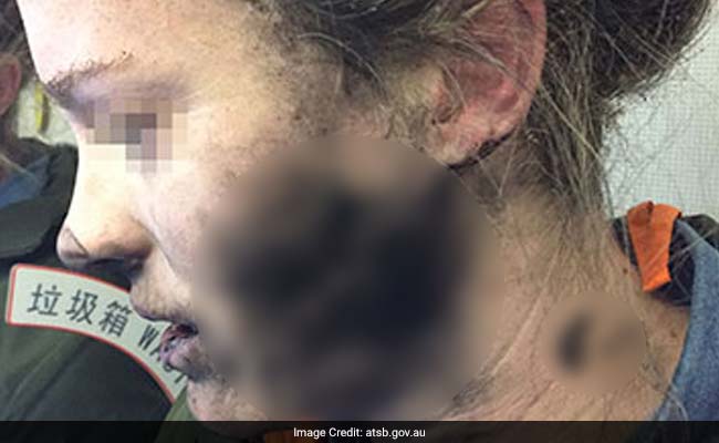 Headphone Batteries Explode On Flight, Her Face And Hands Burnt