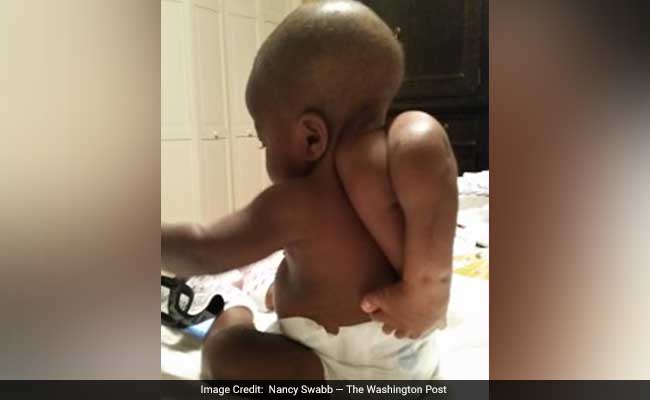 A 10-Month-Old Girl Has Rare Parasitic Twin Removed Surgically From Her Back