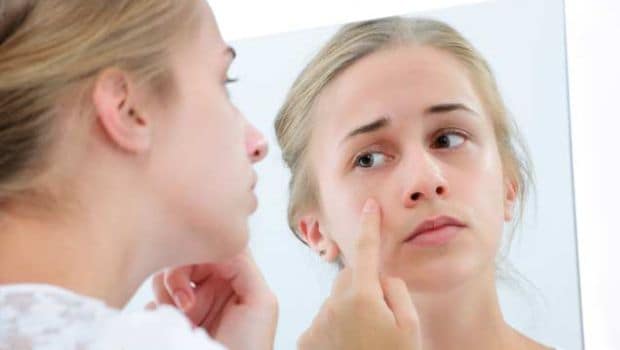 How to Get Rid of Pimples: Try These 5 Amazing Kitchen Ingredients