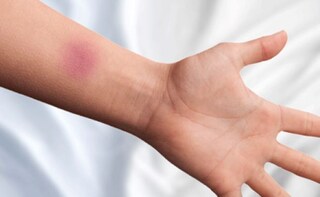 Why Do I Bruise Easily? 8 Pointers to Look Out For